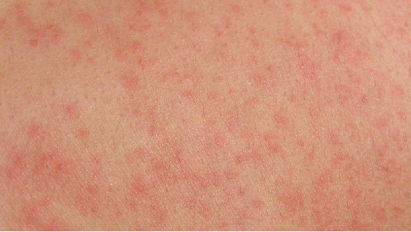 Red dotted skin